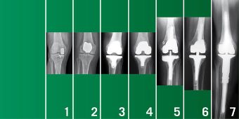 Spektrum Gelenkersatz am Knie