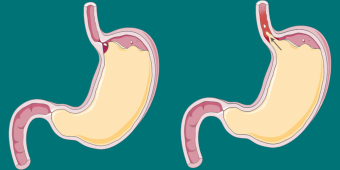 Infografik Refluxkrankheit