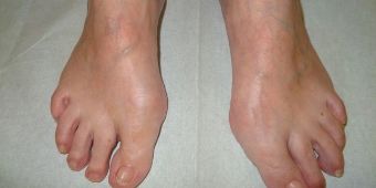 UCHHallux Valgus72