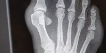 UCHRöntgenbild Spreiz-Senkfuß mit Hallux Valgus72