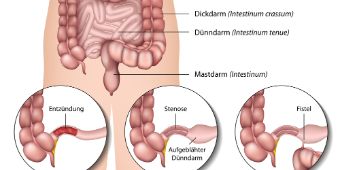 Morbus  Crohn