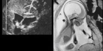 hydrozephalus_diagnostik